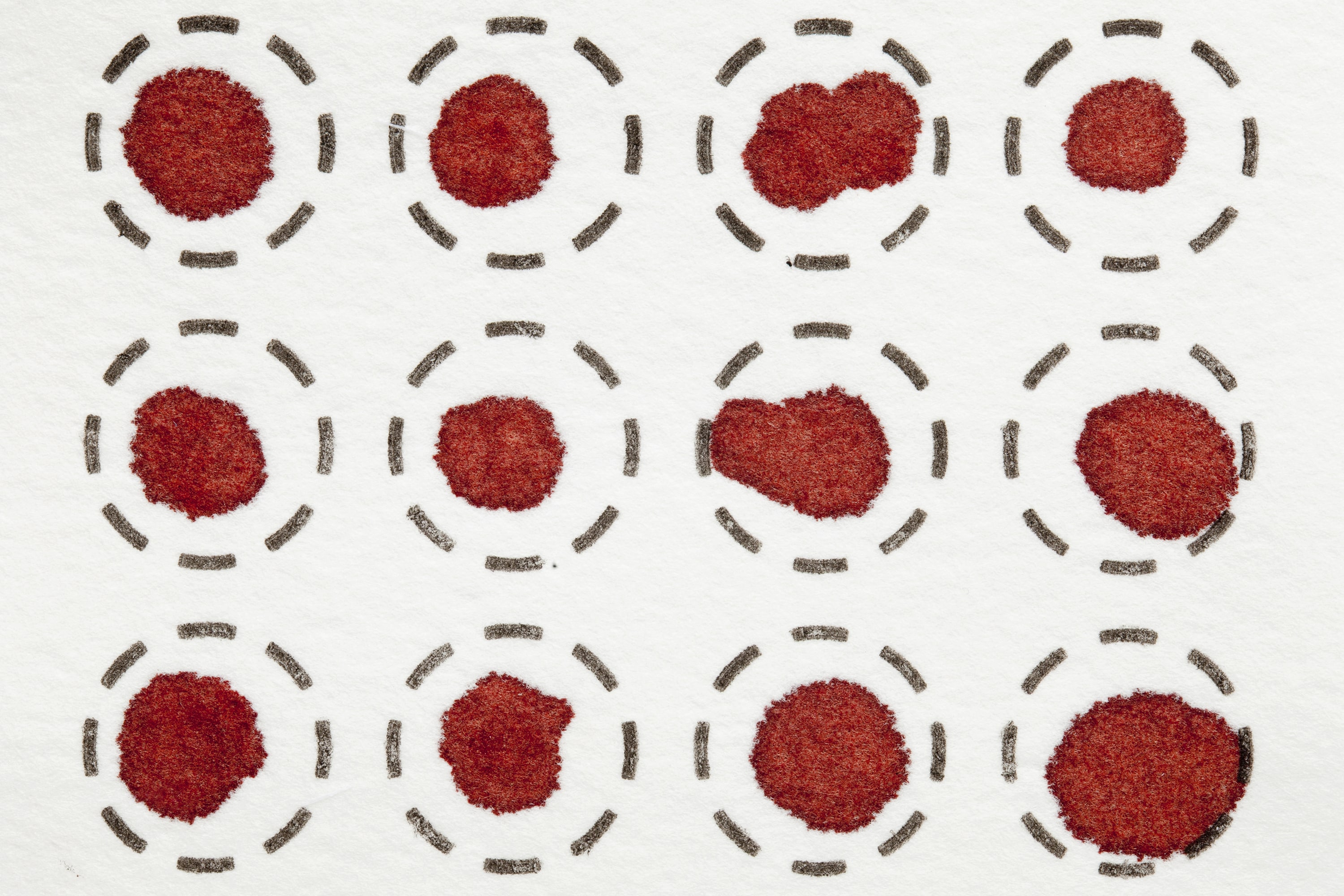 Measurement of Amino Acids and Acylcarnitines in Dried Bloodspots by