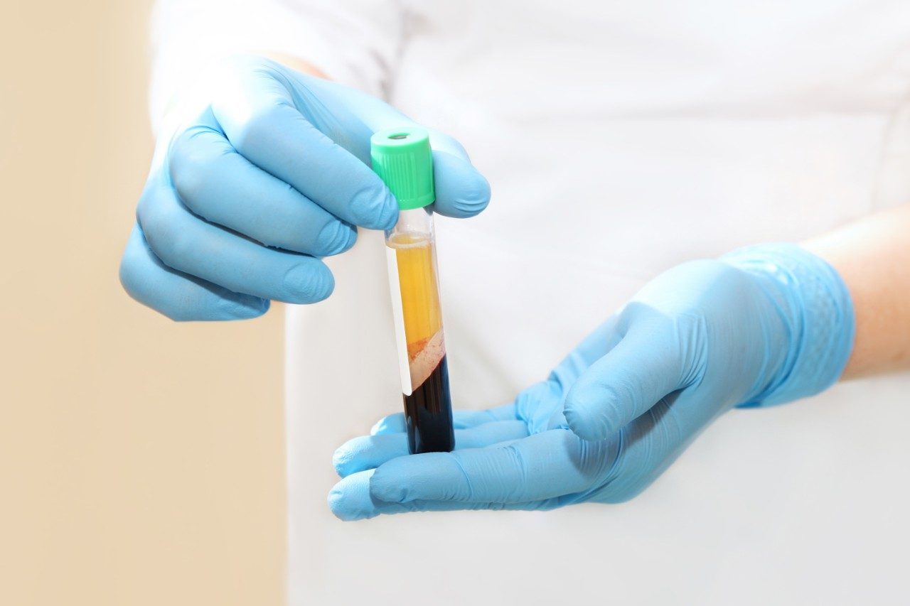 Medical test tube with blood plasma in gloved hands