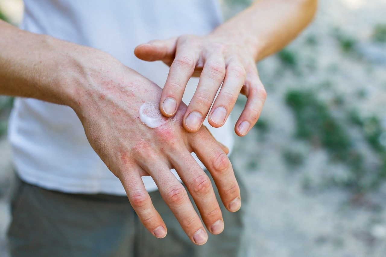 Applying ointment on hand rash