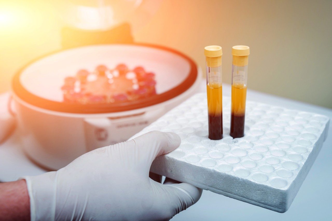 Plasma serum preparation, vials in tray