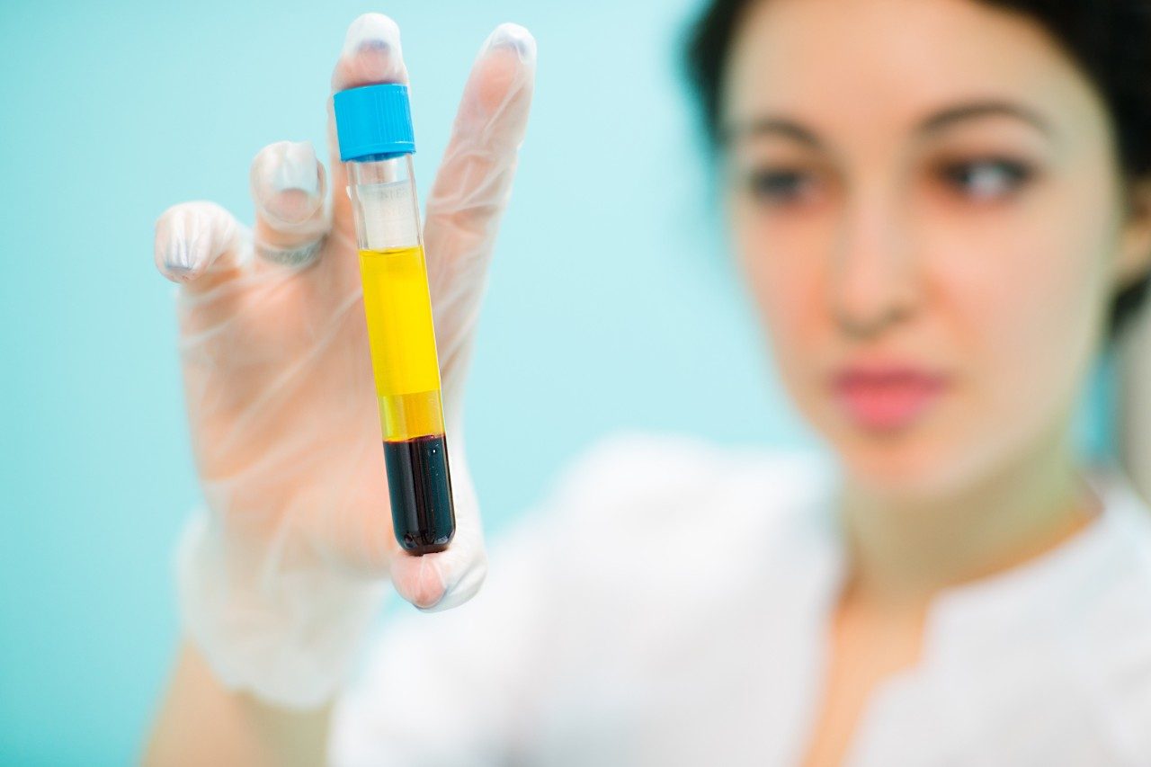 Blood plasma serum in woman's hand