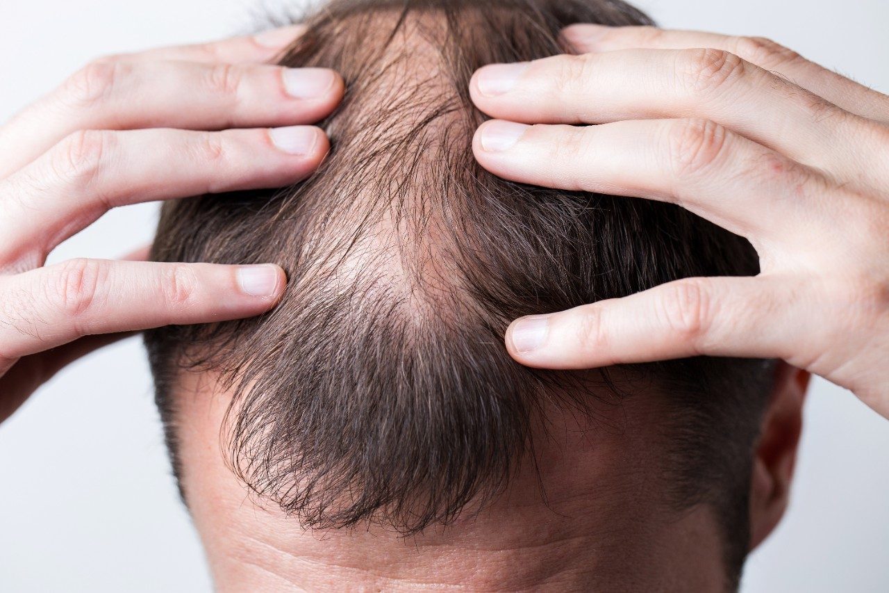 Balding head of young man; alopecia