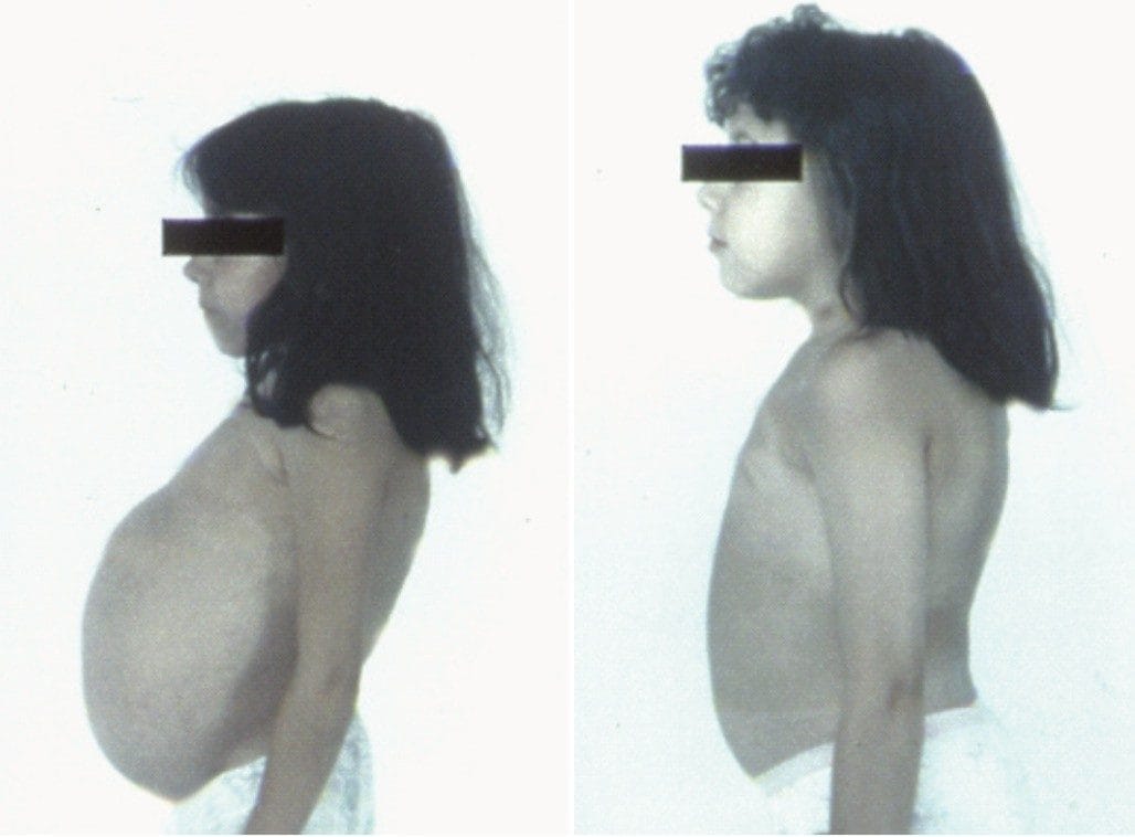  Effect of two-year of enzyme replacement therapy