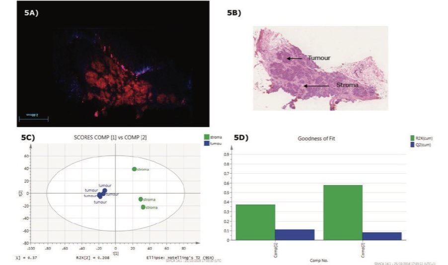 Tissue type differentiations using SIMCA statistical software tool where the ROIs on the stroma and tumor are separated by principal component analysis (PCA). 