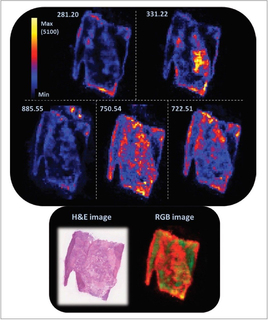 Ion images of specific fatty acids and phospholipids from serous ovarian carcinoma sample 