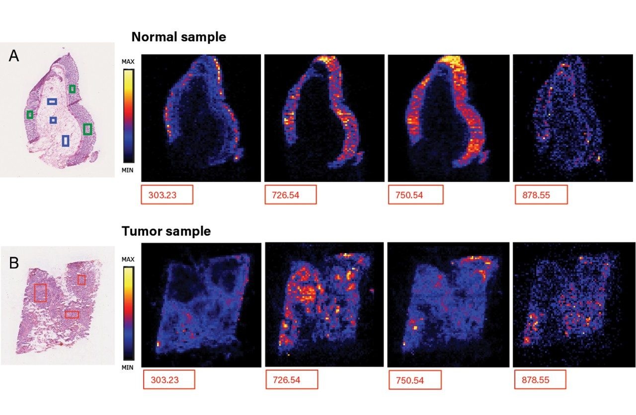 Figure 3. Colorectal tumor and healthy tissue sample analyzed in negative ion mode at  4 scans/second. The same molecules can be found in these two tissue types and due  the nature of the DESI-MS imaging it is also possible to visualize their distribution in  analyzed tissue sections.Putative IDs: m/z 303.23 FA(20:4); m/z 726.54–PE(P-36:2);  m/z 750.54–PE(P-38:4); m/z 878.55–PE(44:8).